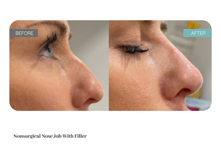 Before and after treatment result — Dr. Lanna, LC Medical Aesthetics NYC